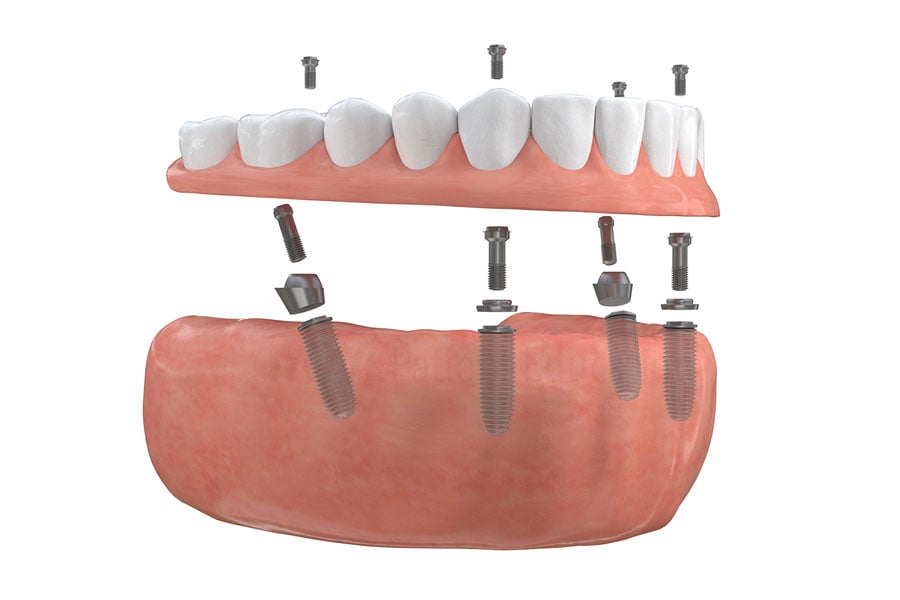 Implant-Supported Full Bridge in Highland Park, IL