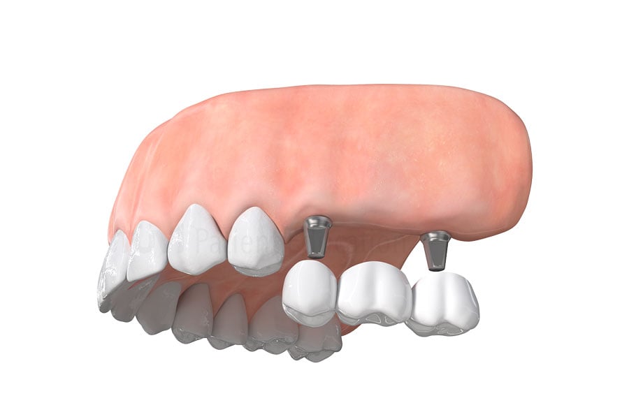 Implant Bridge in Highland Park, IL