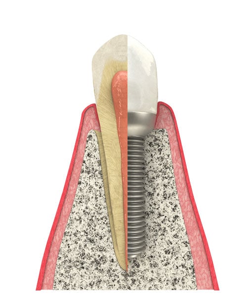 Contact our state-of-the-art dental office in 60035 to see if you are a candidate for dental implants in Highland Park, IL. Dental Implant in Highland Park, IL
