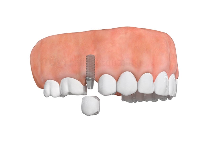 Are you embarrassed of your smile? Contact our state-of-the-art dental office in 60035 to see if you are a candidate for dental implants in Highland Park, IL. Dental Implant in Highland Park, IL