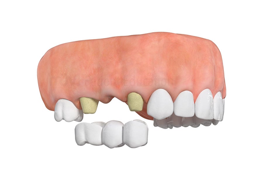 Schedule a dental consultation with Dr. Sam Skurie, well-qualified cosmetic dentist in Highland Park IL, to restore your teeth with dental implants near 60035. Traditional Bridge in Highland Park, IL
